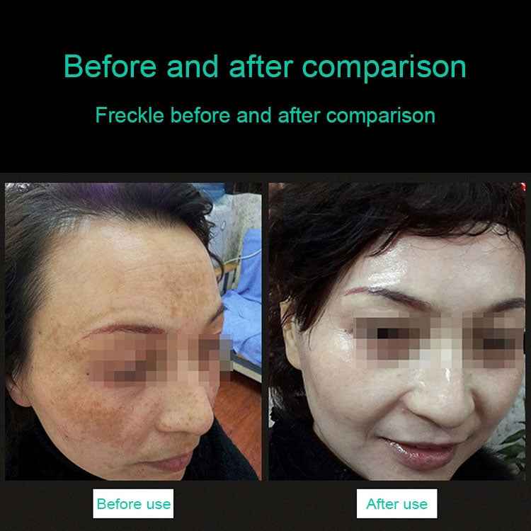 Handheld Picosecond Portable (Removing Tattoo Freckle Mole Dot) Machine Laser Plasma Beauty Care Pen