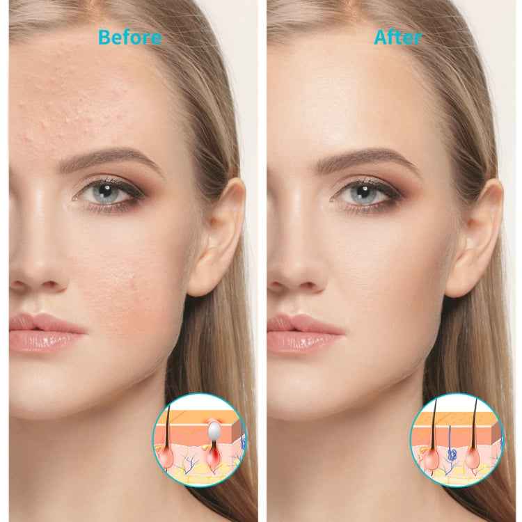 XPREEN XPRE052 Wireless Rechargeable Light Acne Treatment Device Home Acne Clearing Eraser with Blue Light and Red Light