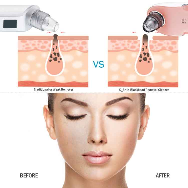 K-SKIN 3 Level Intensity Blackhead Removal Pore Cleaner Suction Rechargeable Black Spot Cleaner Facial Cleaning Machine