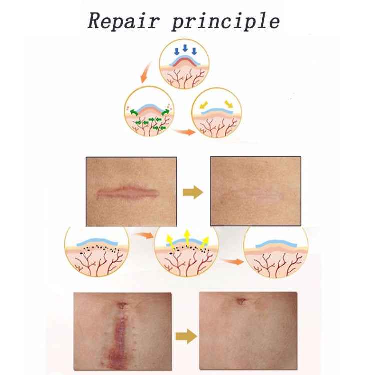 Organic silicone Gel Scar Therapy Patch be Washed and Reused