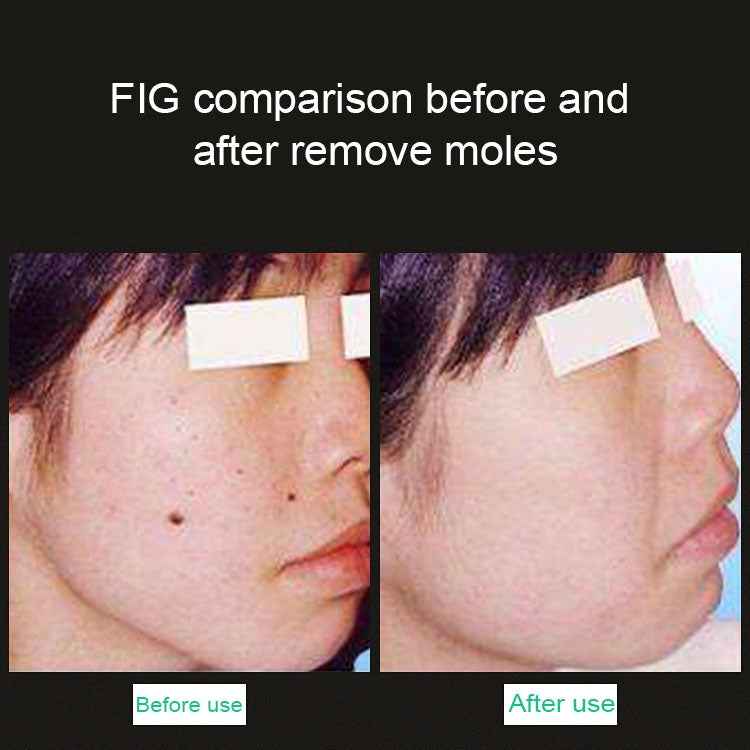 Handheld Picosecond Portable (Removing Tattoo Freckle Mole Dot)  Machine Laser Plasma Beauty Care Pen