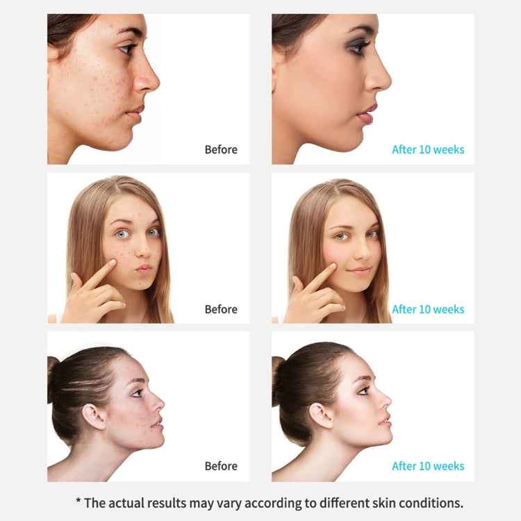 Xpreen Rechargeable Pore Cleanser Home Facial Beauty Device with LED Screen & 4 Probes